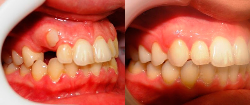  Выравнивание зубов брекетами (вид сбоку)