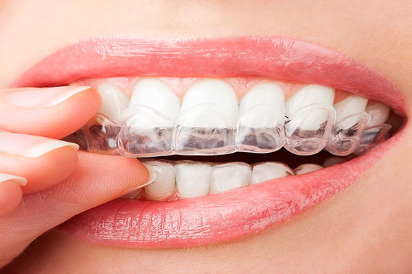 elajnery dlja vyravnivanija zubov
