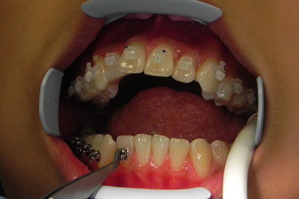 Фиксация брекетов на зубах
