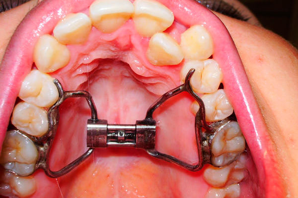 Несъёмная ортодонтическая пластина