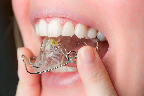 Съёмная ортодонтическая пластинка