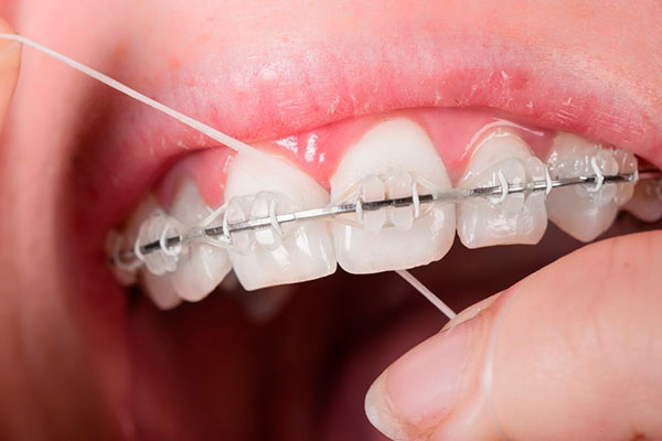 Уход за зубами с помощью зубной нити